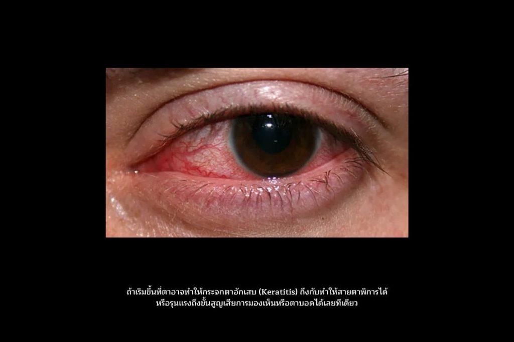 กระจกตาอักเสบ (Keratitis)