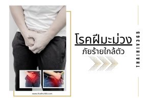 โรคฝีมะม่วง ภัยร้ายใกล้ตัว